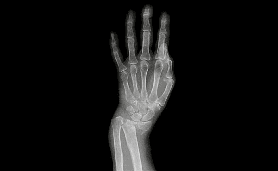 złamany nadgarstek rtg
